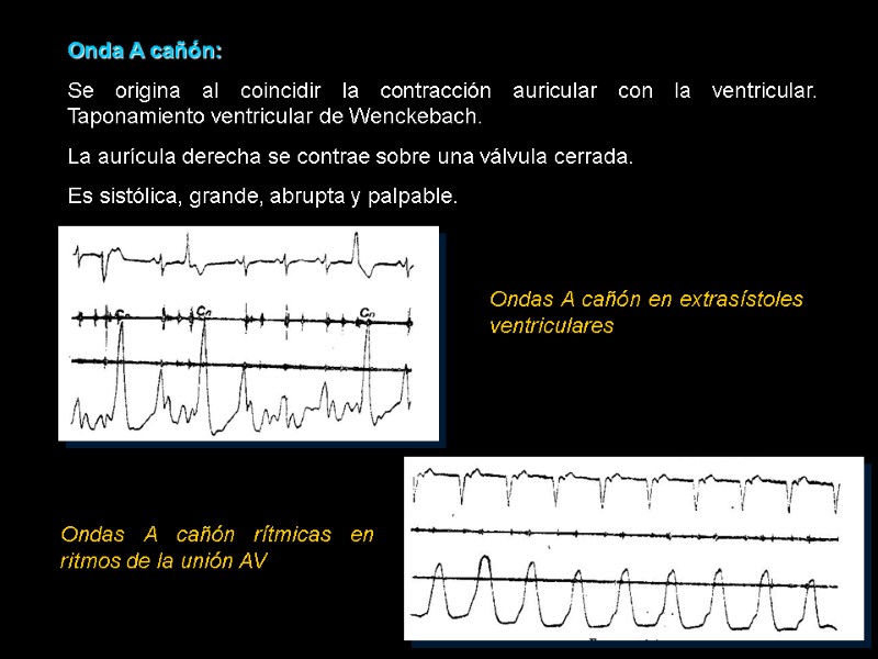 Onda A cañón: Se origina al coincidir la contracción auricular con la ventricular. Taponamiento